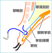 瞼板に固定