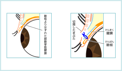 挙筋前転法（信州大学式）