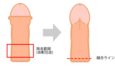 陰茎根部環状切開法