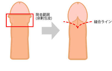 亀頭直下Ｖ字環状切開法