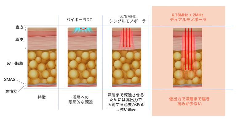 デュアル周波数